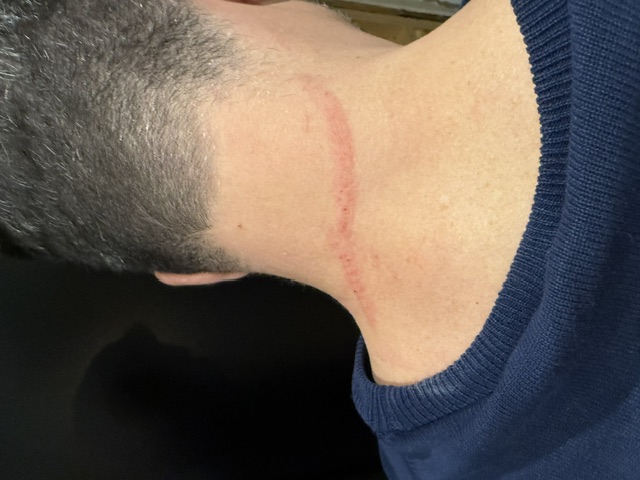 Photo de l'égratignure sur le cou du demandeur